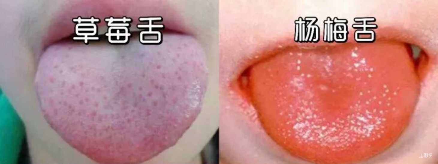 传染性强、无疫苗！上海有幼儿被症状蒙蔽，拖成血尿！相关资料 10