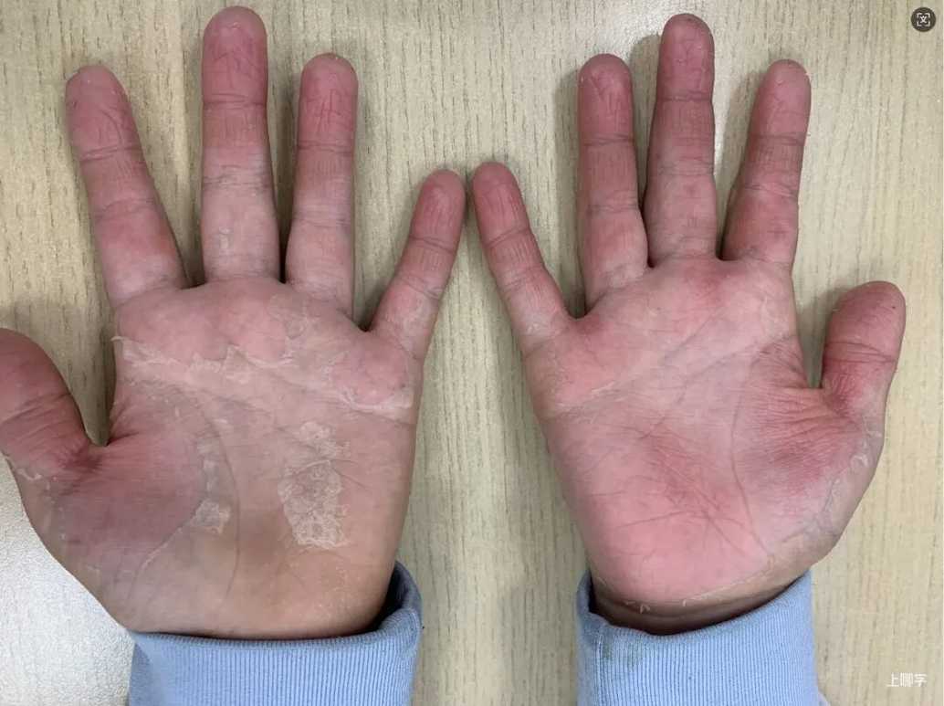 传染性强、无疫苗！上海有幼儿被症状蒙蔽，拖成血尿！相关资料 7